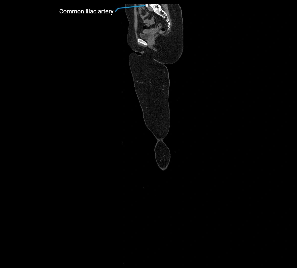 CTA lower limb sagittal cross sectional anatomy labelled image _1 (5).webp
